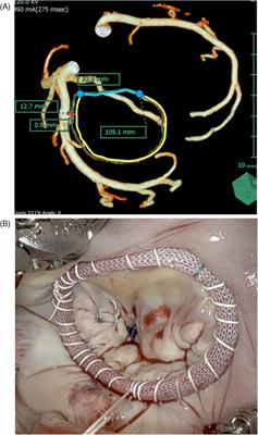 Three-dimensional computed tomography analysis of the mitral annulus for mitral annuloplasty in 100 cases of robotic mitral valve repair